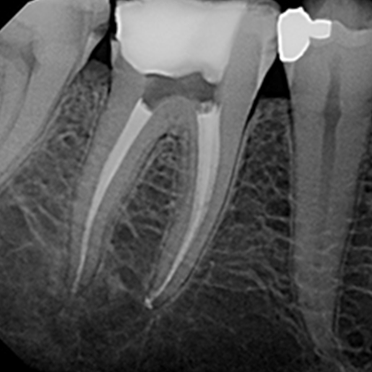 Endodontsko lečenje zuba