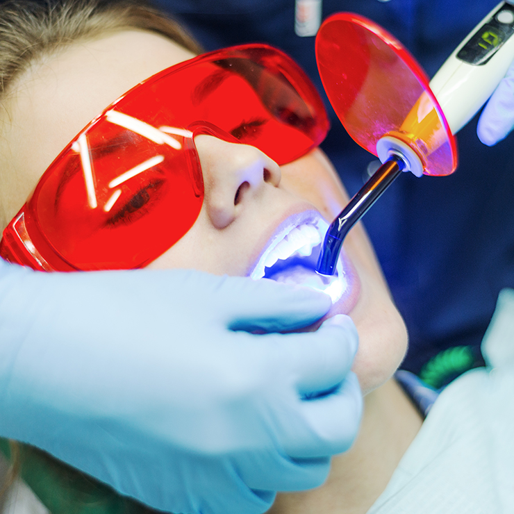 Lasersko beljenje zuba