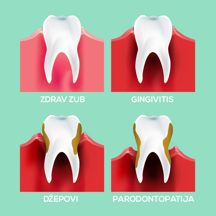 Šta je parodontopatija?