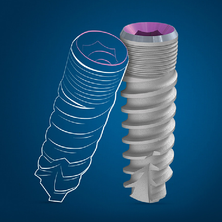 Šta su dentalni implantati?