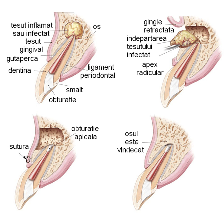 Šta je apikotomija?
