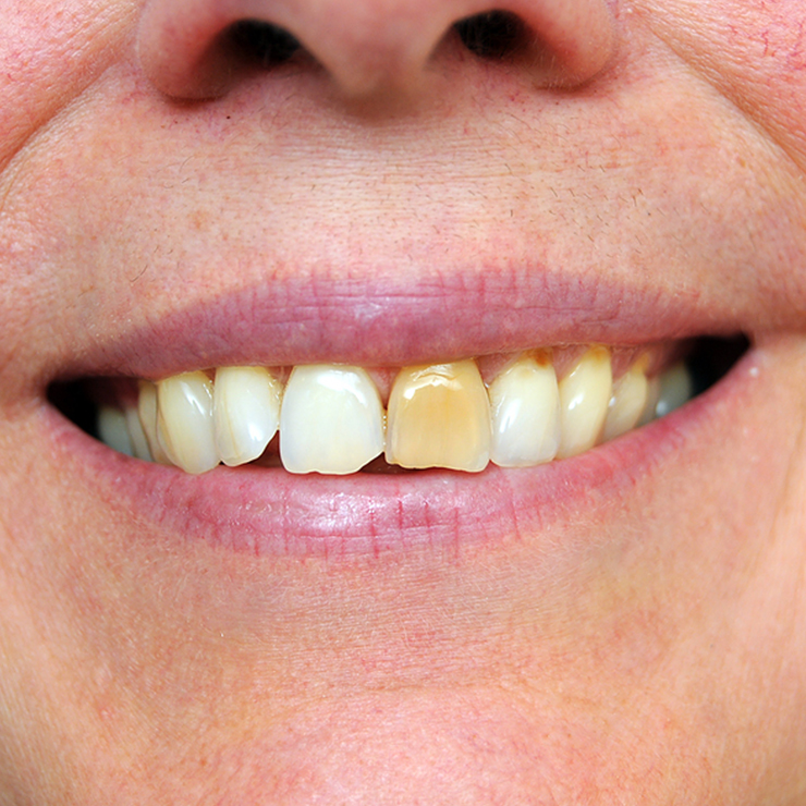 Why does a tooth get darker?