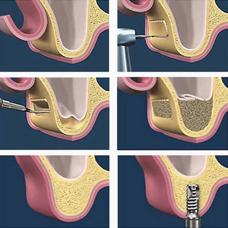 What is a sinus lift?