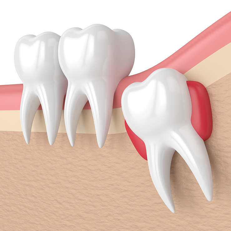 Why do we have problems with wisdom teeth?