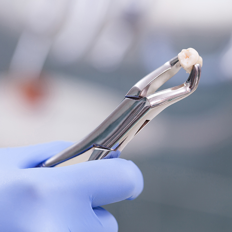What is tooth extraction?