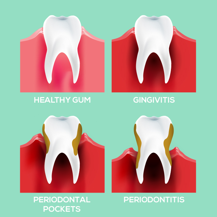 What is paradontopathy?