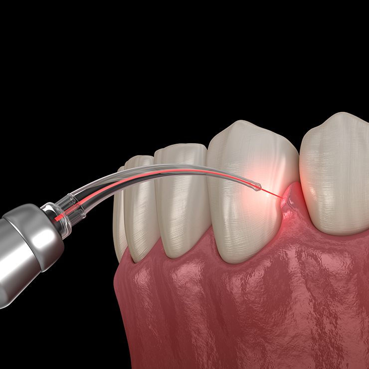 Parodontopatija se leči