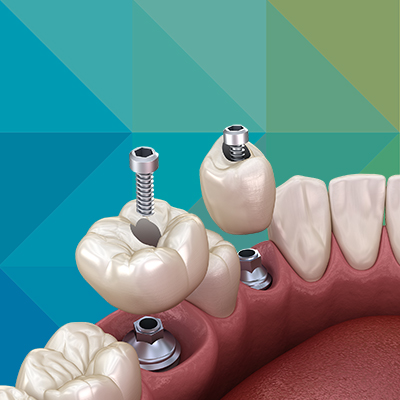 Prednosti radova na šraf