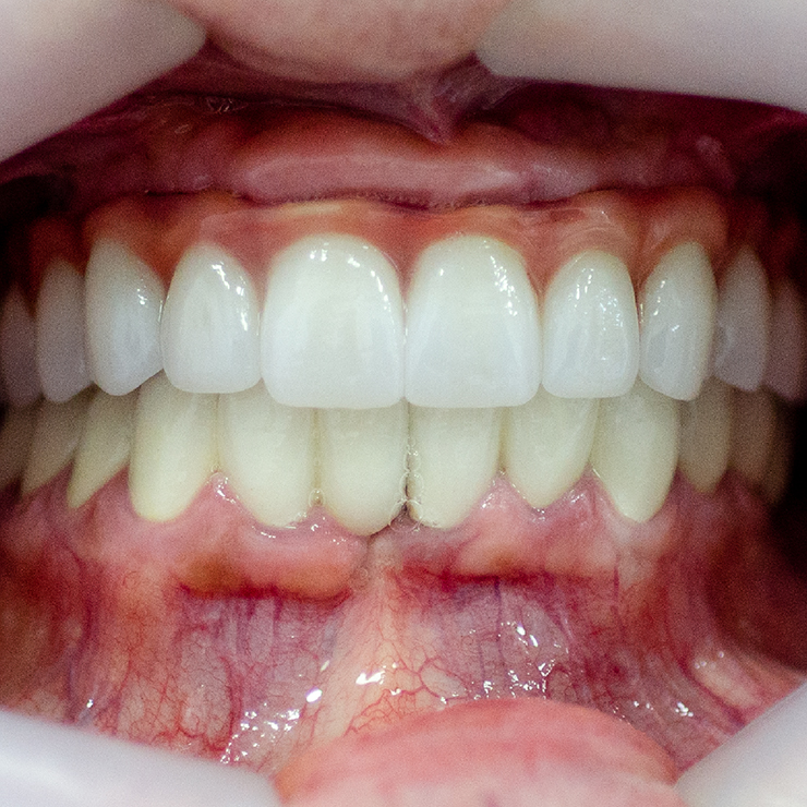 Protetski ALL ON 4 radovi