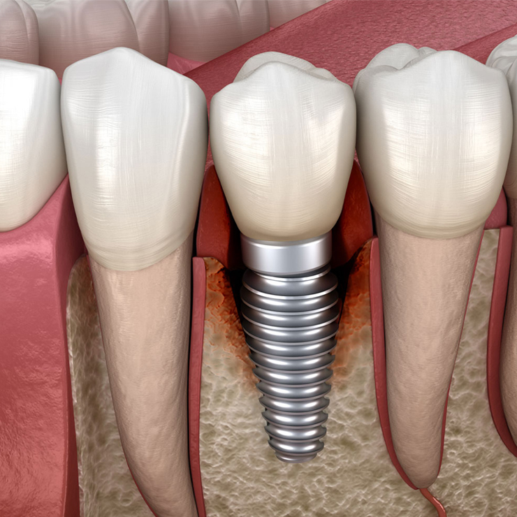 Simptomi odbacivanja implanta