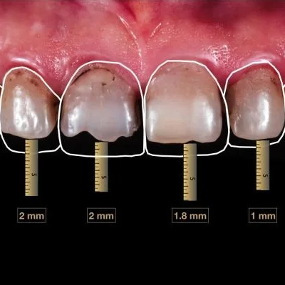 Digital Smile Design