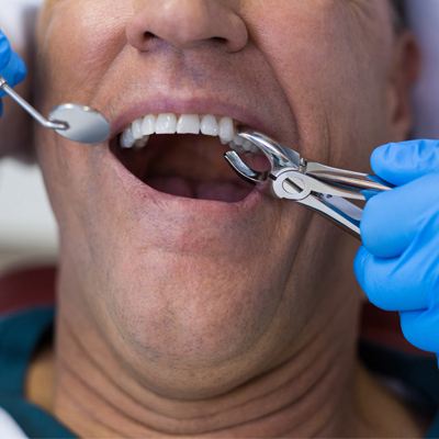 Zašto je otvoren sinus prilikom vađenja zuba